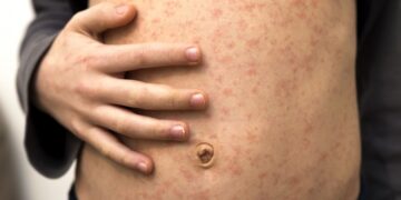 Confirmaron en CABA un caso de sarampión importado desde Medio Oriente